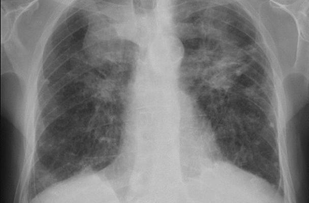 A lung x-ray of a miner with Progressive Massive Fibrosis (PMF), the most severe form of black lung. Many in Appalachian suffer from it